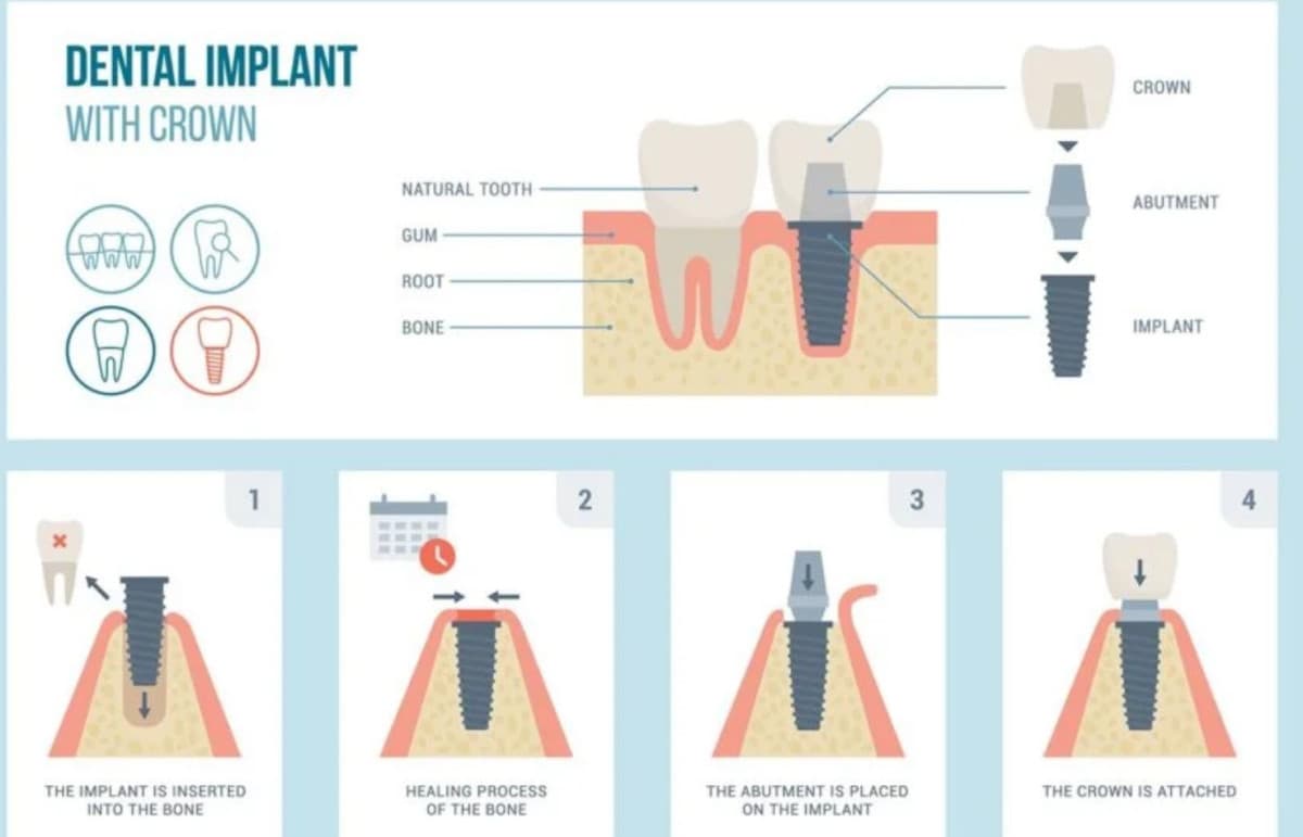 Fort Worth Clinic Makes Dental Implants More Accessible Through Strategic Management